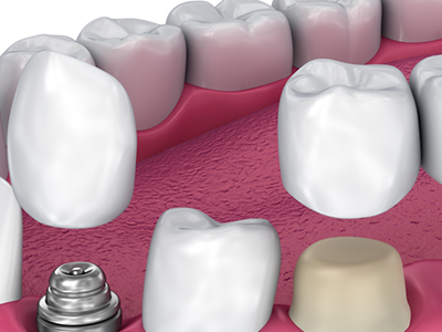 Kron-Kopru-Protezleri1