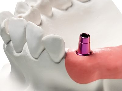 realizzazione-protesi-fissa-impianto-singolo