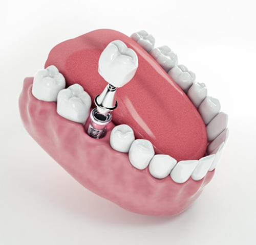 cuando-colocarme-implante-dental-1