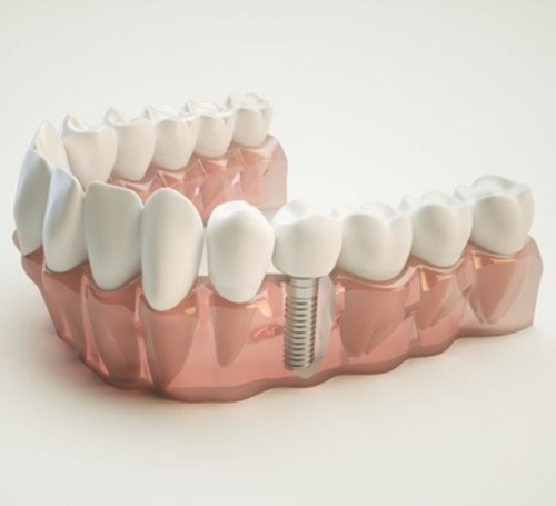 implant-dis-tekdis2-1