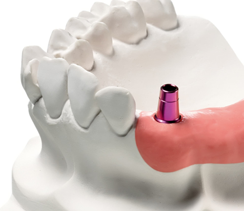 realizzazione-protesi-fissa-impianto-singolo-1